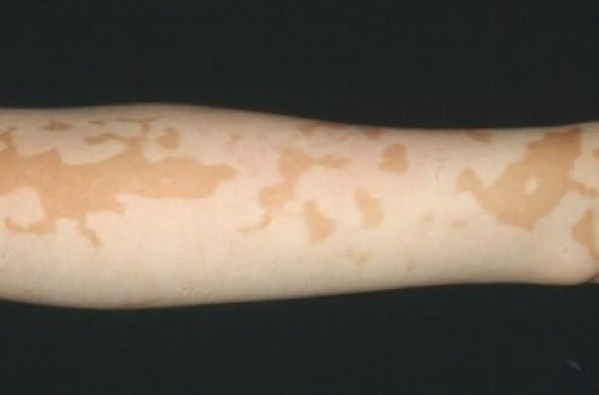 백반증의 피부 병변. 서울대병원 제공