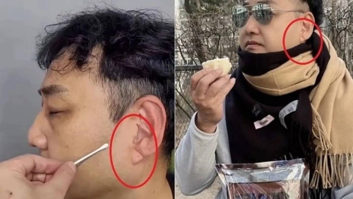 개그맨 김수용(59)이 최근 갑자기 의식을 잃고 쓰러져 급성 심근경색을 진단받은 가운데, 그의 귓불에 있던 사선 주름이 전조증상이라는 주장이 제기됐다. 김수용 인스타그램 캡처