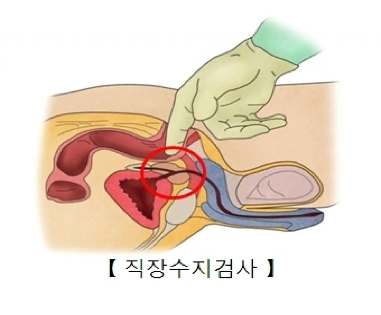 전립선암을 진단할 때 의사가 손가락을 항문에 넣어 촉진하는 직장수지검사법 / 서울아산병원