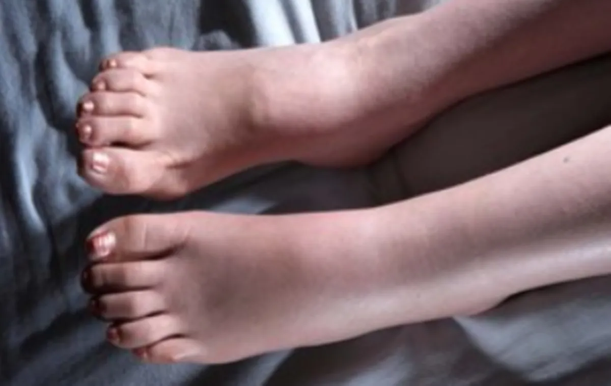 사진 : 부종 / 생성형 이미지