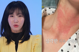 기사로 이동 - 이수경, 정체불명 피부병 고백…“대인기피증 생겨, 은퇴까지 생각”