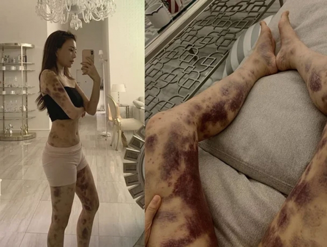 thumbnail - 아옳이, 13억 명예훼손 소송서 최종 승소…“전신 피멍 사진, 허위 아니었다”