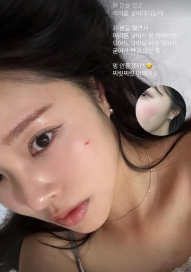 thumbnail - ‘박성광♥’ 이솔이, 예상치 못한 얼굴 부상...“닦아도 닦아도 피가”