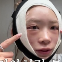 thumbnail - 최준희, 충격! 광대+눈 성형 과정 낱낱이 공개...“이번 수술은 좀 무서웠다”