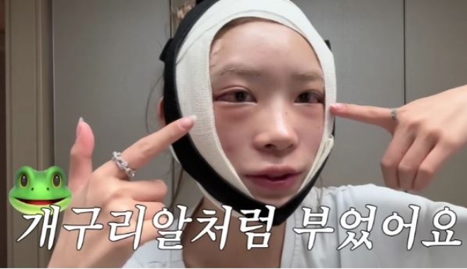 thumbnail - 최준희, 충격! 광대+눈 성형 과정 낱낱이 공개...“이번 수술은 좀 무서웠다”
