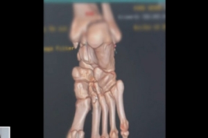 기사로 이동 - ‘강철 파이터’도 속수무책… 50세 추성훈, 뼈 2개 박살난 ‘이 사고’