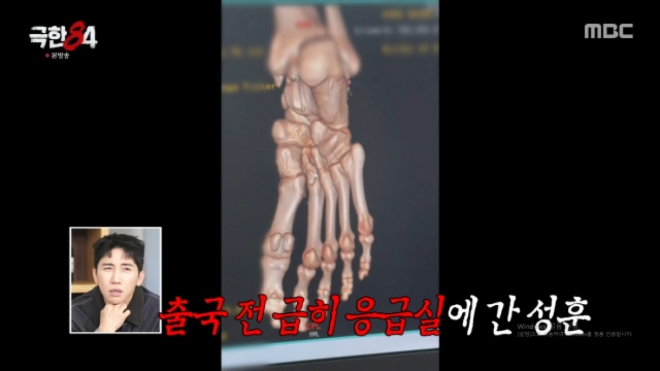 thumbnail - ‘강철 파이터’도 속수무책… 50세 추성훈, 뼈 2개 박살난 ‘이 사고’