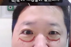 기사로 이동 - “큰 병 앓는 줄 알았네”… 정형돈, 성형 직후 공개한 ‘충격 모습’