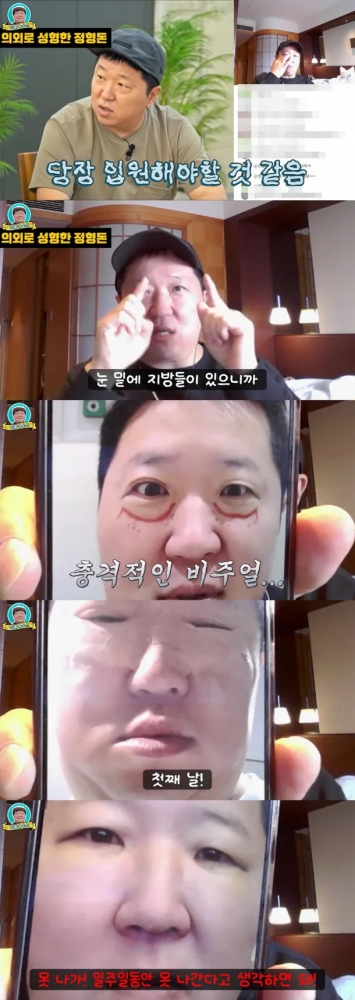 thumbnail - “큰 병 앓는 줄 알았네”… 정형돈, 성형 직후 공개한 ‘충격 모습’