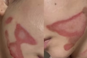 기사로 이동 - “엄마가 보고 우셨다”… 미용 시술 받다 ‘2도 화상’ 입은 걸그룹 그녀