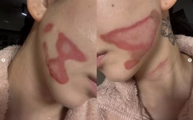 thumbnail - “엄마가 보고 우셨다”… 미용 시술 받다 ‘2도 화상’ 입은 걸그룹 그녀