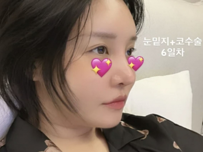 thumbnail - “좀 더 착해진 것 같기도”… 랄랄, 성형 6일 차 얼굴 공개