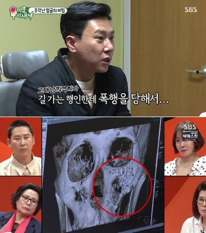 thumbnail - “코뼈가 휘면 인생이 꼬인다더니”… 이상민, 전치 8주 사건의 전말