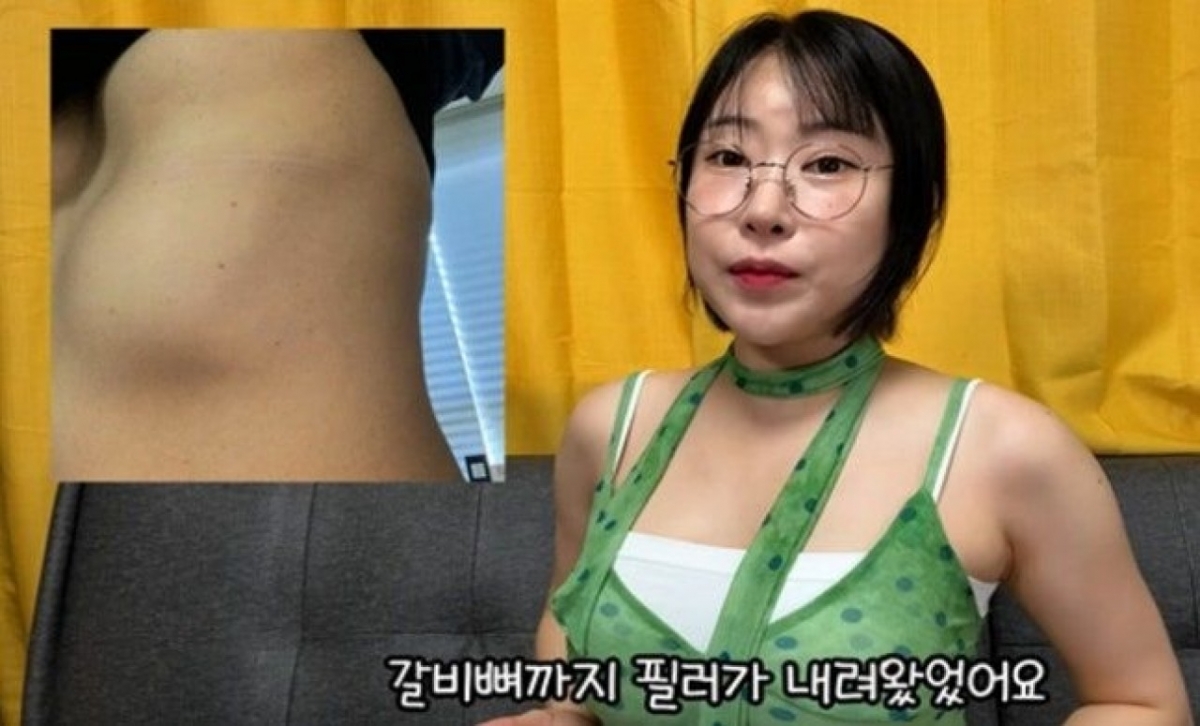 thumbnail - “가슴 4개 되고 갈비뼈까지…” 이세영이 공개한 필러 부작용