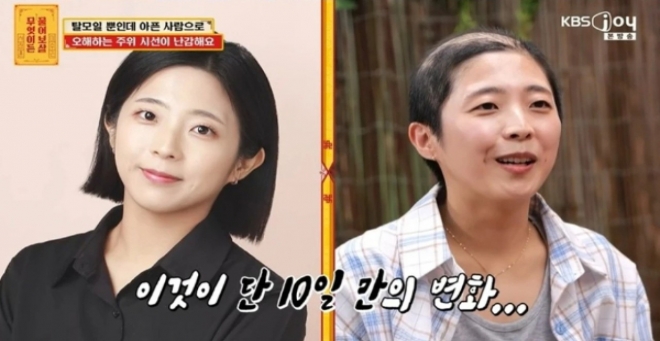 thumbnail - 10일 만에 ‘풍성한 대머리’ 된 33세 여성, 충격적인 현재 상태