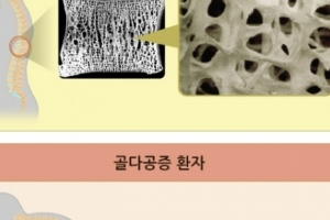 기사로 이동 - “80세 할머니보다 뼈가…” 성전환 30년차 하리수, 이 주사 안 맞다 들은 진단명