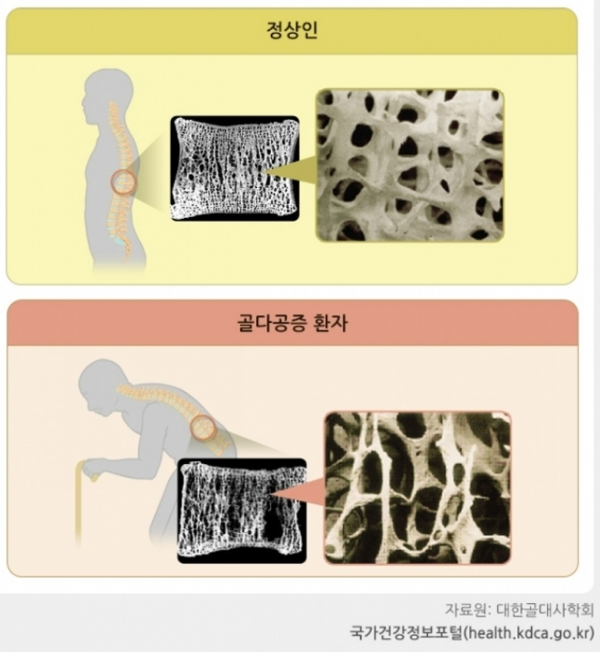 thumbnail - “80세 할머니보다 뼈가…” 성전환 30년차 하리수, 이 주사 안 맞다 들은 진단명